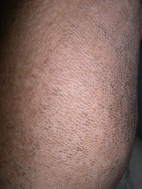 ichthyosis vulgaris pictures