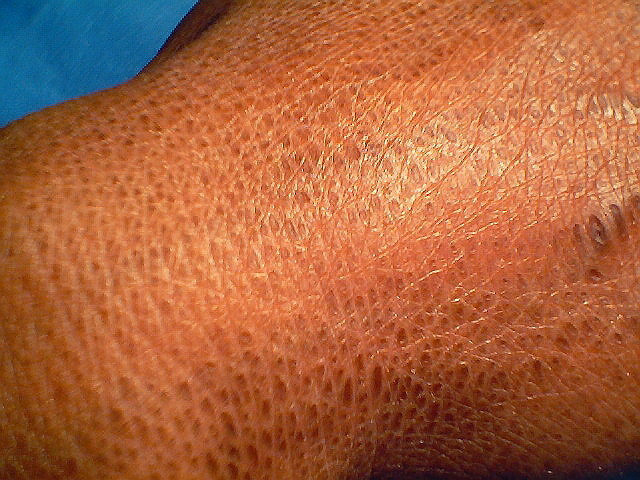 Ichthyosis Vulgaris Pictures Pictures Photos