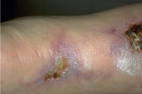 heat rashes on legs. jun related in heat rash