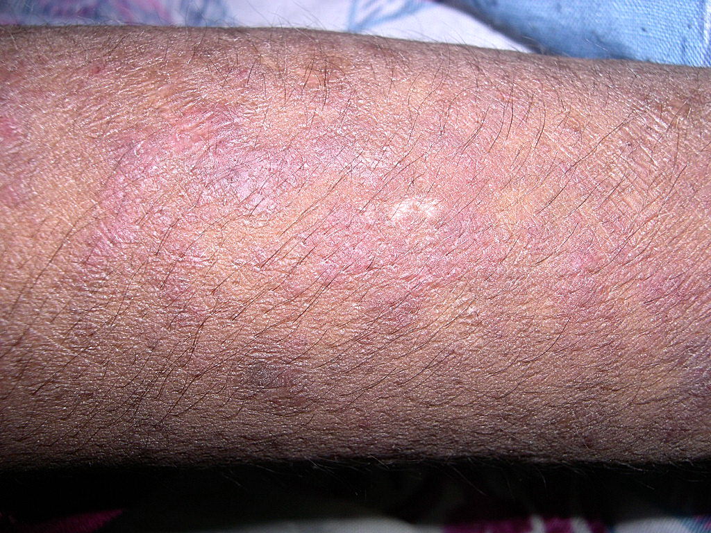 Xeroderma | definition of xeroderma by Medical dictionary