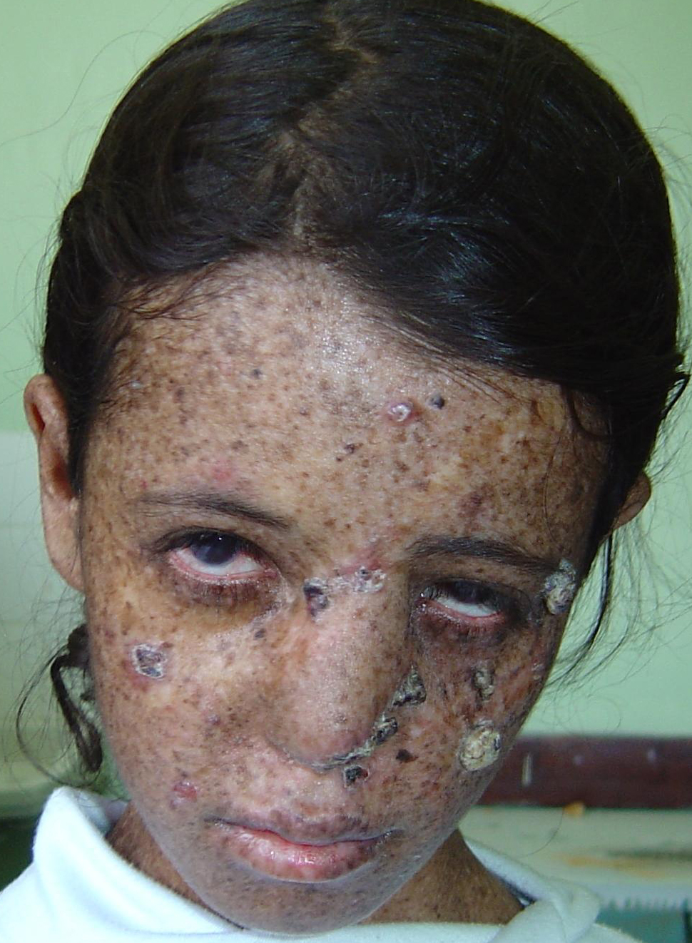 Xeroderma pigmentosum = جفاف الجلد المصطبغ