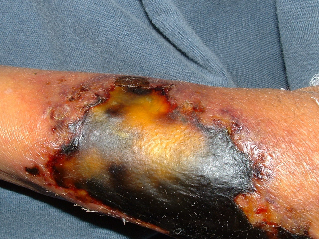 Mucormycosis - Wikipedia