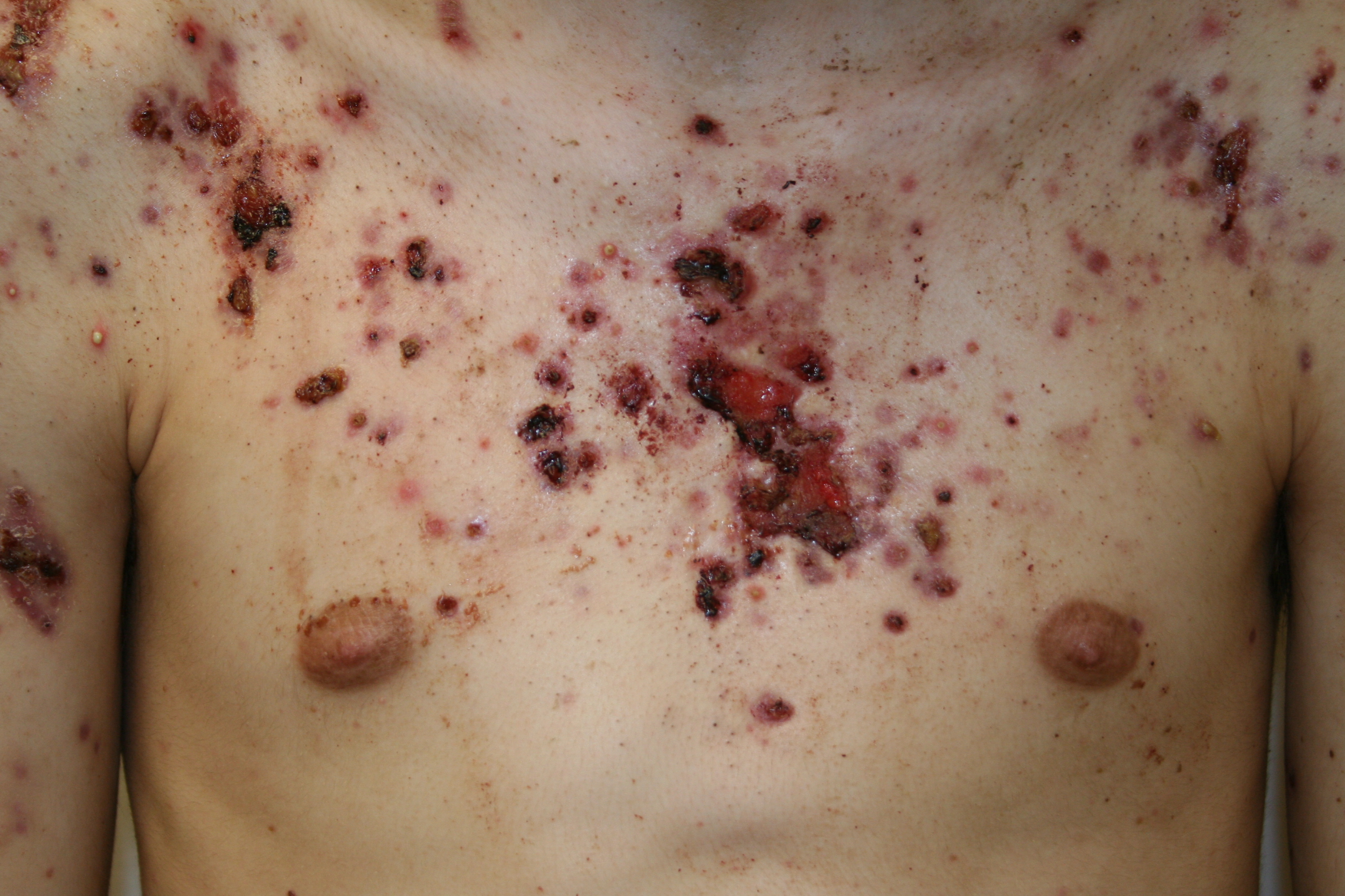 acne-fulminans25.jpg