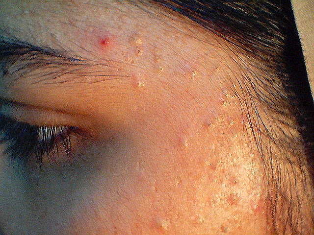 different kinds of skin rashes #11