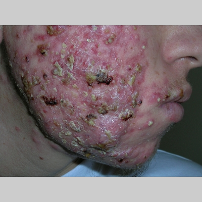 Acne conglobata=العد المكبب‎