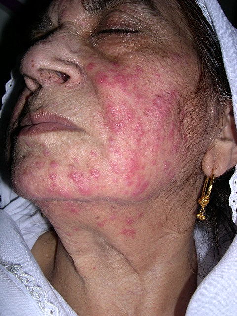 Forehead rash - check medical symptoms at RightDiagnosis