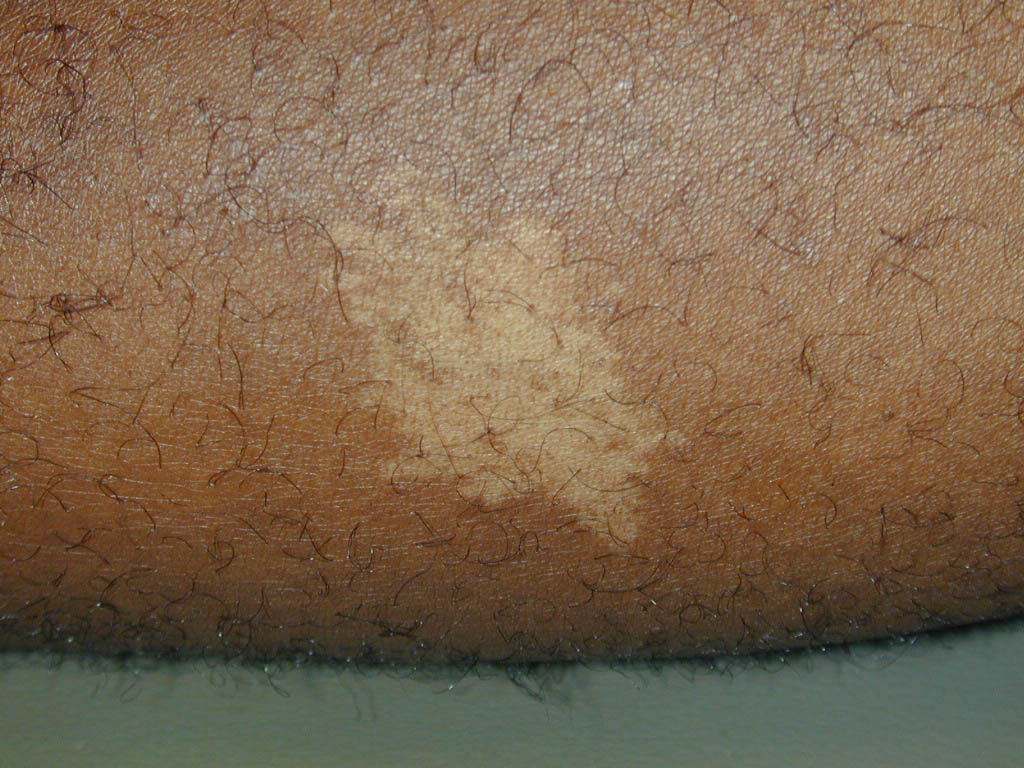 Ash-leaf macule | definition of ash-leaf macule by Medical ...