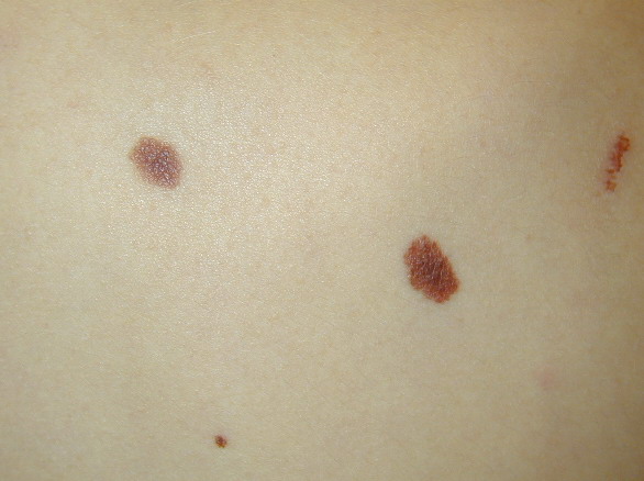 Mole Or Skin Cancer? - Health.com