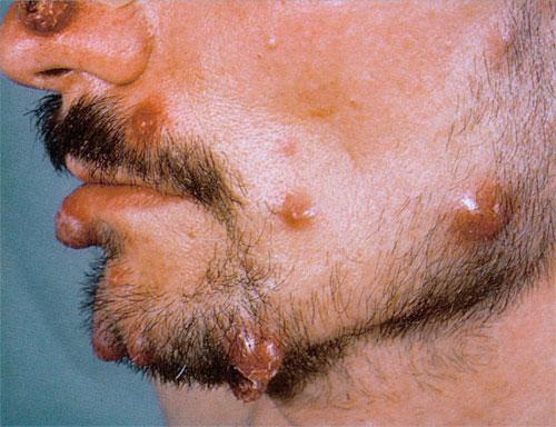 Bacillary angiomatosis - Wikipedia