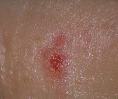 What Are Basal and Squamous Cell Skin Cancers?