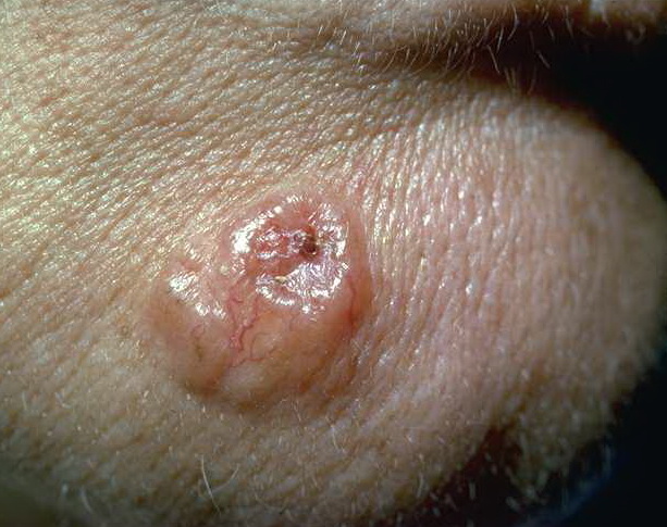 Five Warning Signs of Basal Cell Carcinoma - SkinCancer.org
