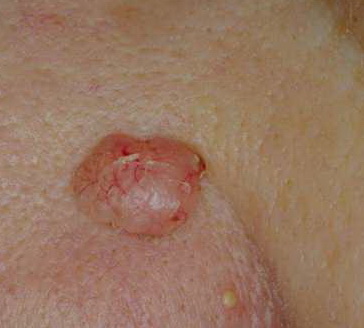 Skin Cancer: Basal and Squamous Cell