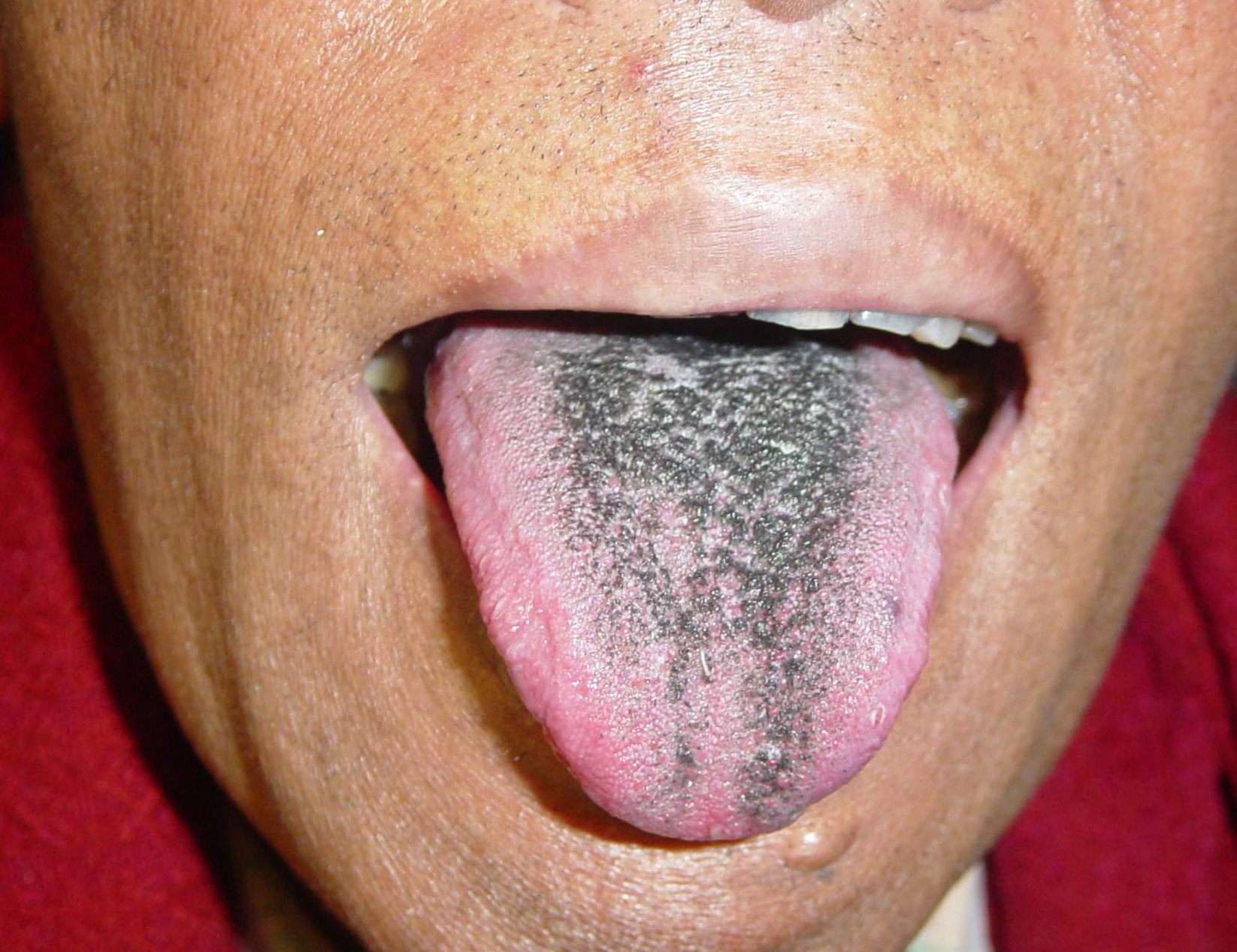hairy tongue white or black hairy tongue hairy tongue hypertrophy