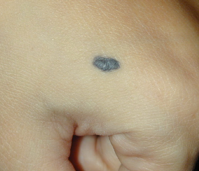Pictures of Skin Diseases and Problems - Blue Nevus