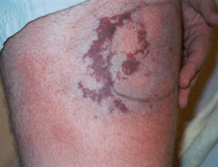 spider bites symptoms in children. spider bites pictures.