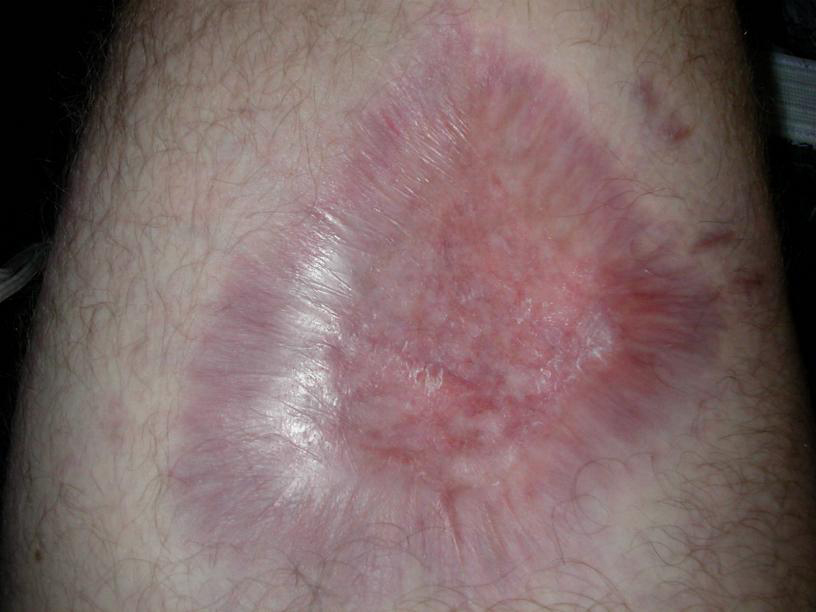 brown recluse spider bite treatment. rown recluse spider bite