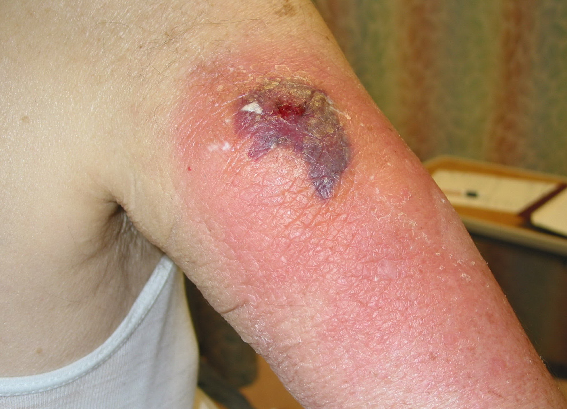 cellulitis antibiotics #10