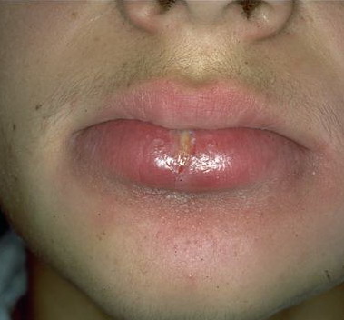 Allergic contact cheilitis - Ophaswongse - 2006 - Contact ...