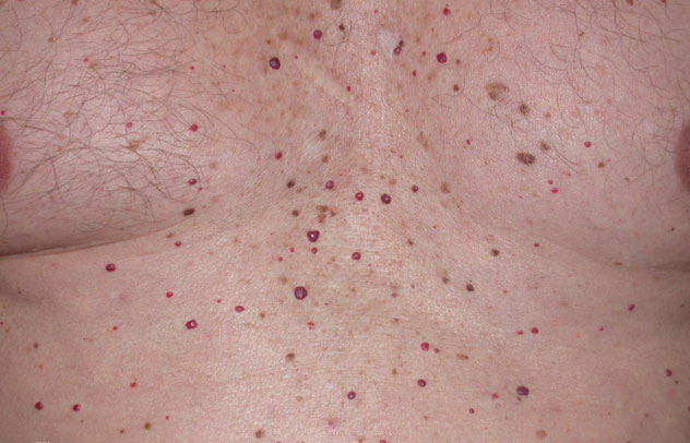 Hemangioma As Related To Cherry Angioma Pictures