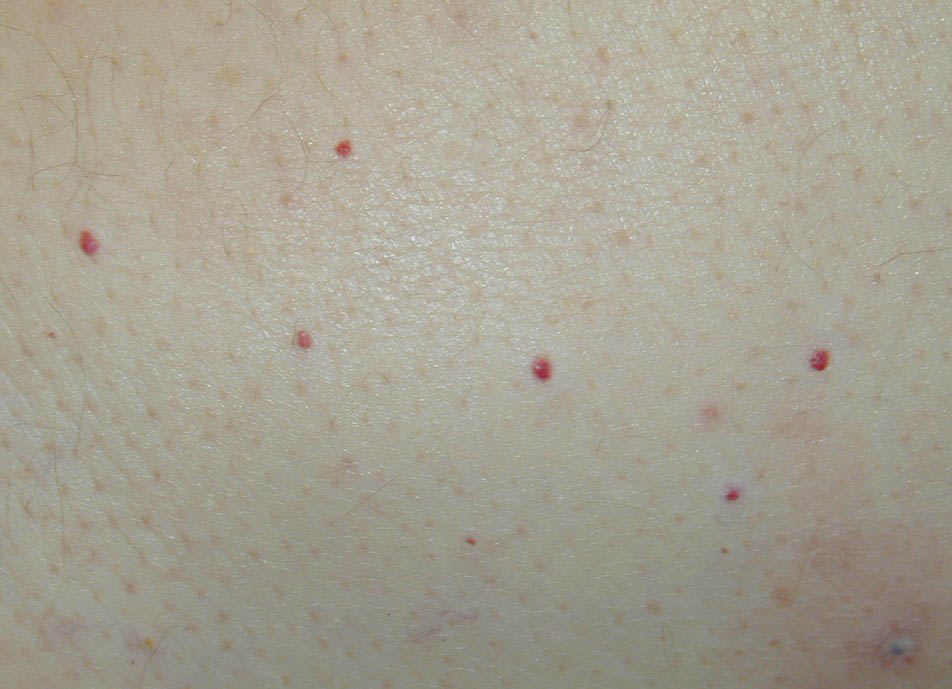 Red Dots on Legs - Pictures, Symptoms, Causes, Treatment