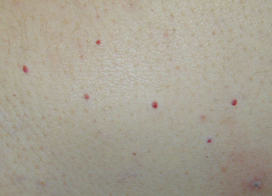 millions small red dots all over legs under skin no itch ...