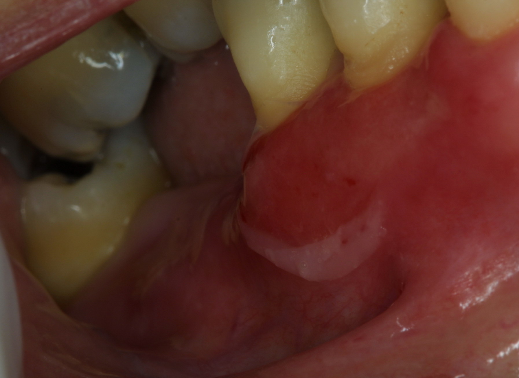 pemphigoid oral