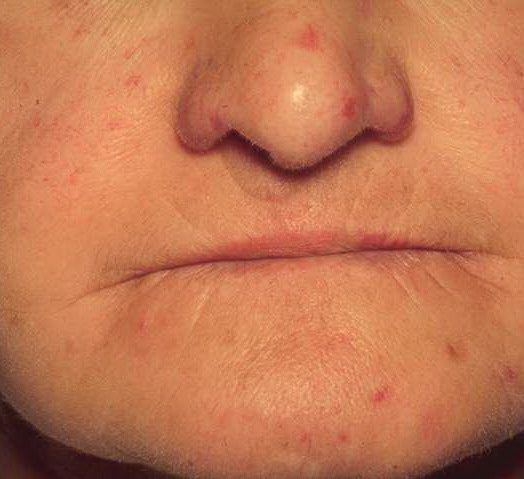 What treatments are used for CREST syndrome?