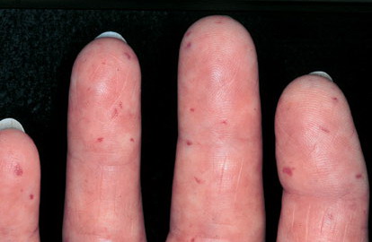 Sclerodactyly: MedlinePlus Medical Encyclopedia Image