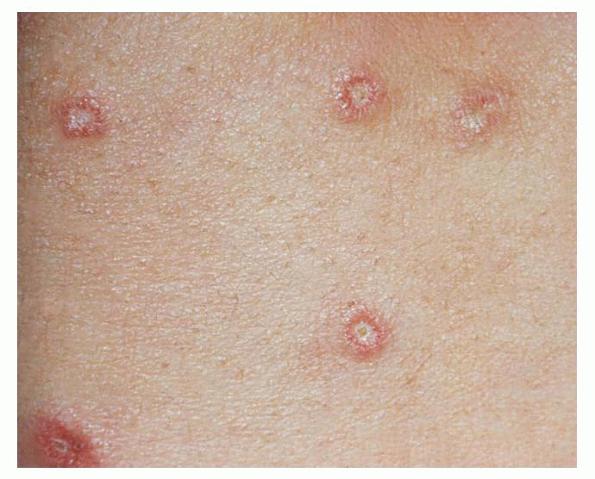 Dowling Degos disease (reticulate pigmented dermatosis of ...