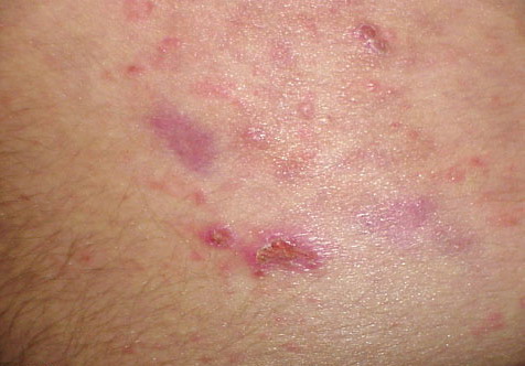 dermatitis herpetiformis image