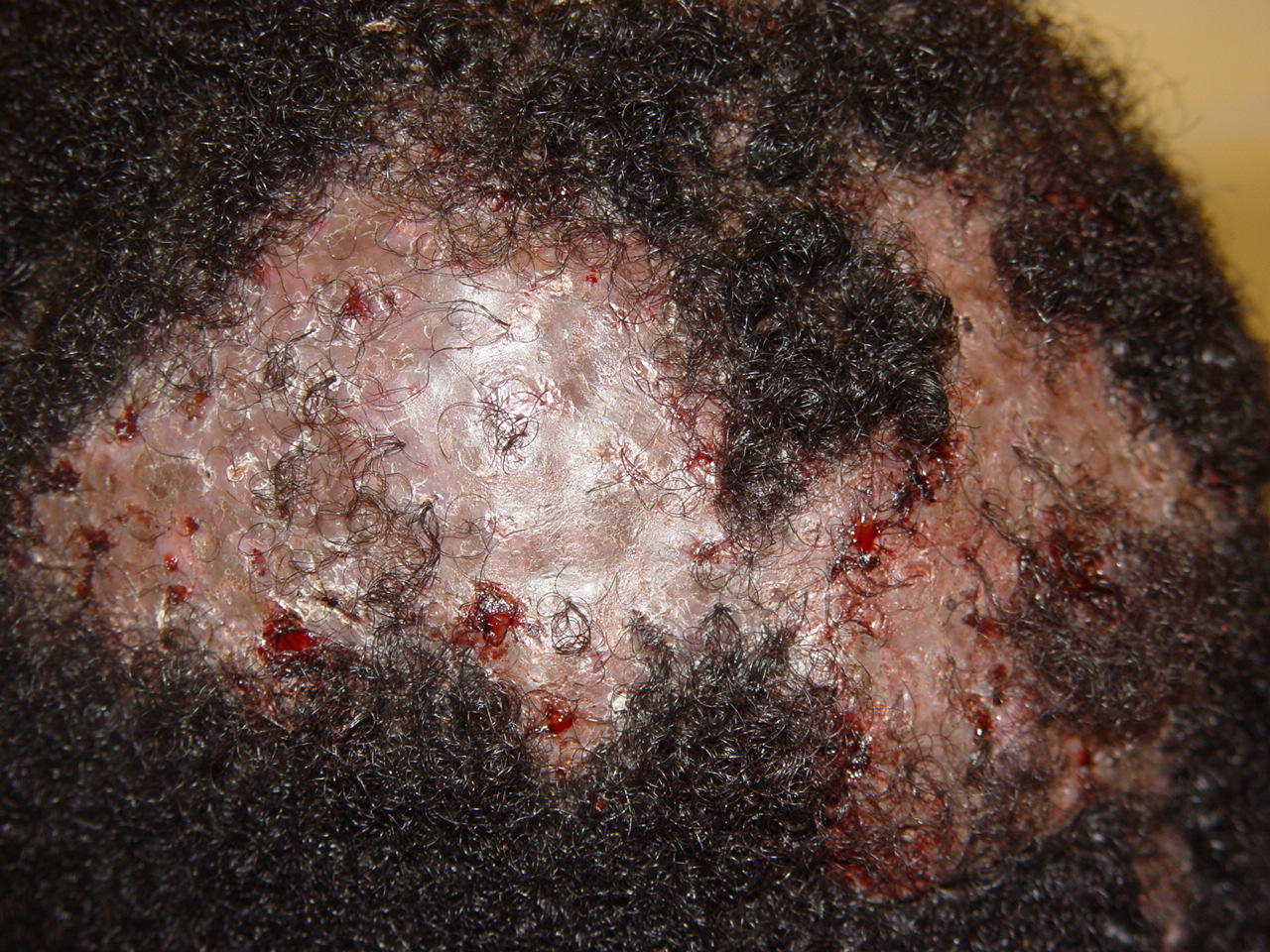 scalp cellulitis