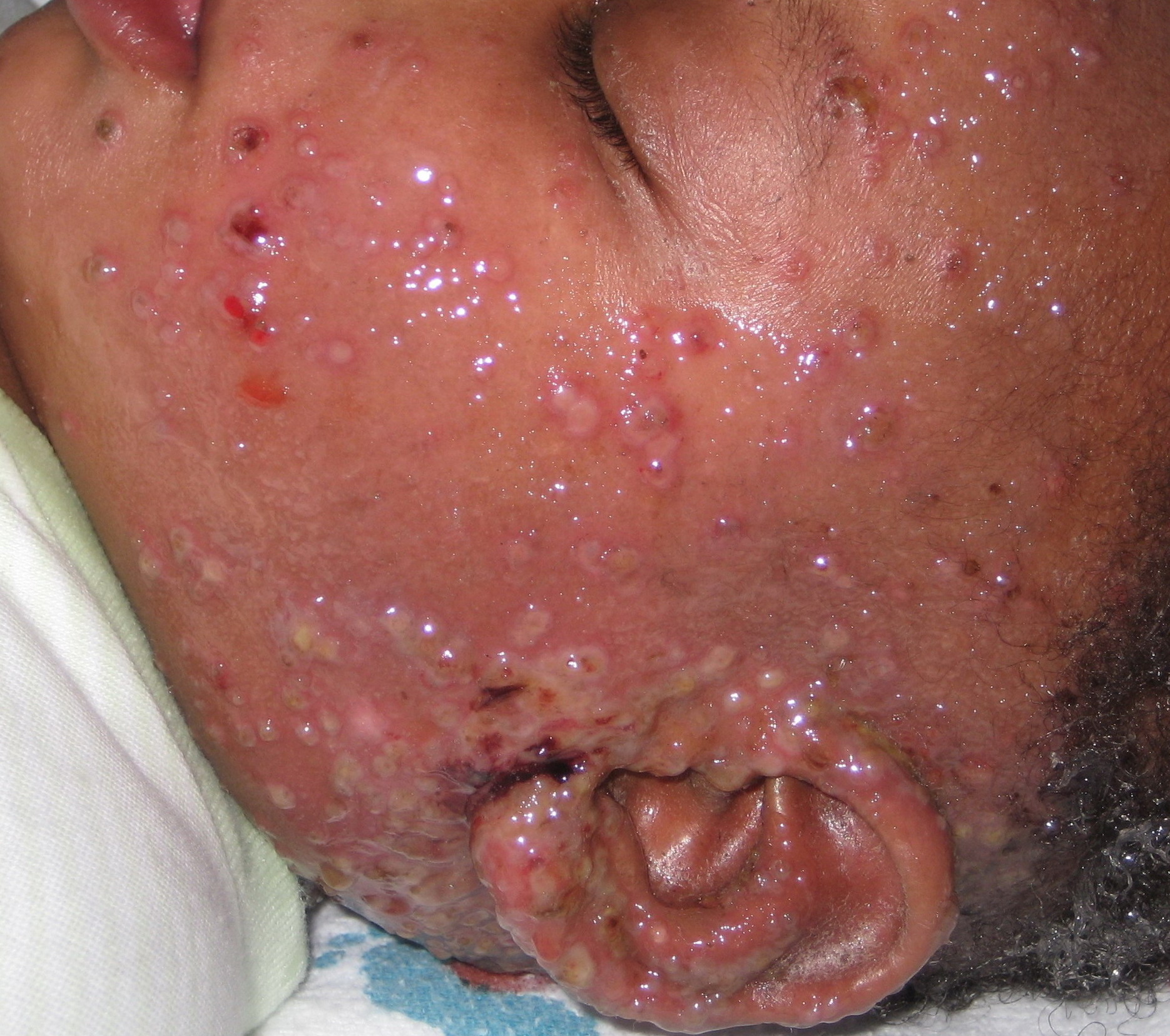 Picture of Eczema Herpeticum - WebMD