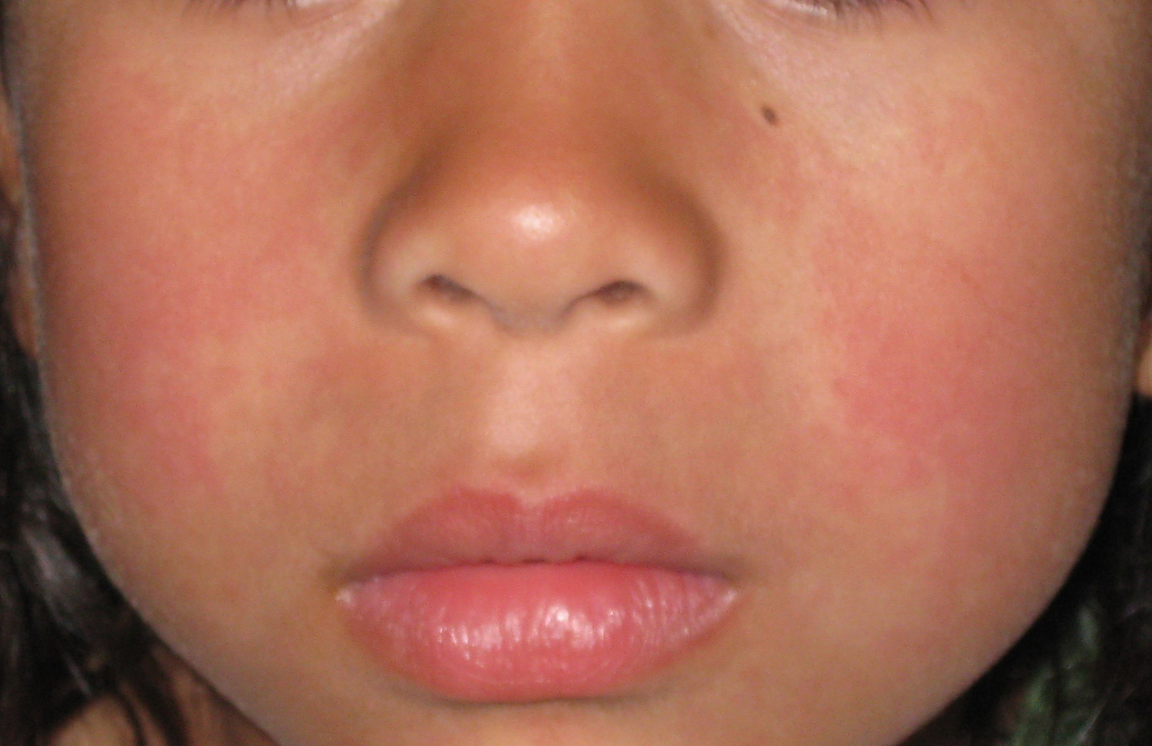 fifths disease rash pictures pictures, photos