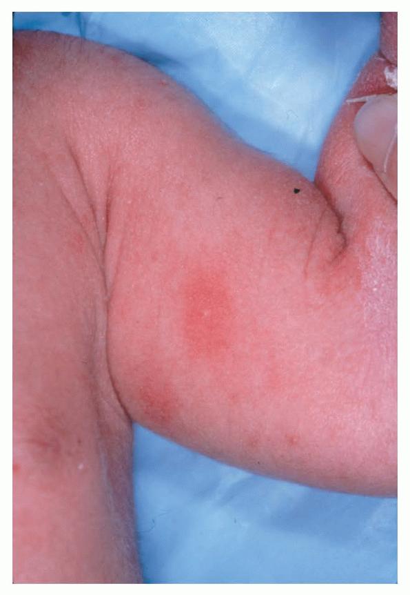 Toxic erythema | Article about toxic erythema by The Free ...