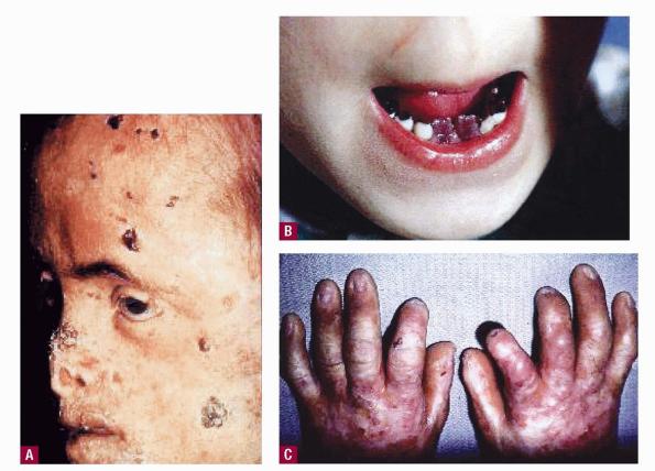 Porphyria - Wikipedia