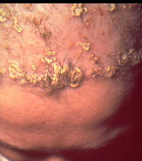 scalp folliculitis pictures #10