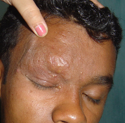 Treatment of Idiopathic Follicular Mucinosis With ...