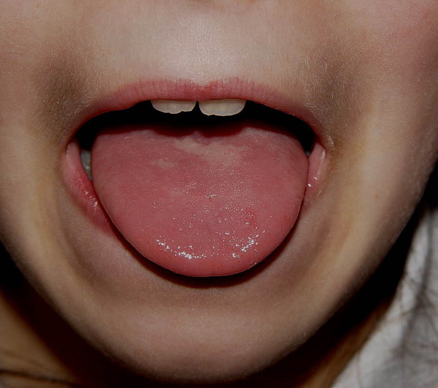 Geographic Tongue-Treatment, Pictures, Symptoms, Causes