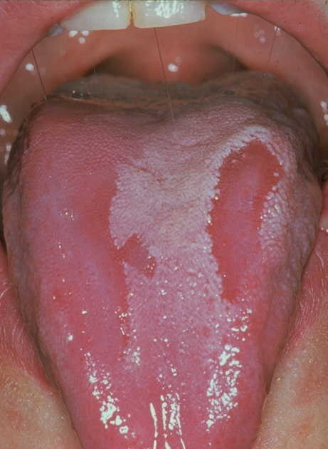 Geographic Tongue Picture Image on MedicineNet.com