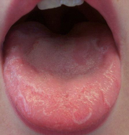 Pictures of Mouth and Tongue Disease - ENT USA