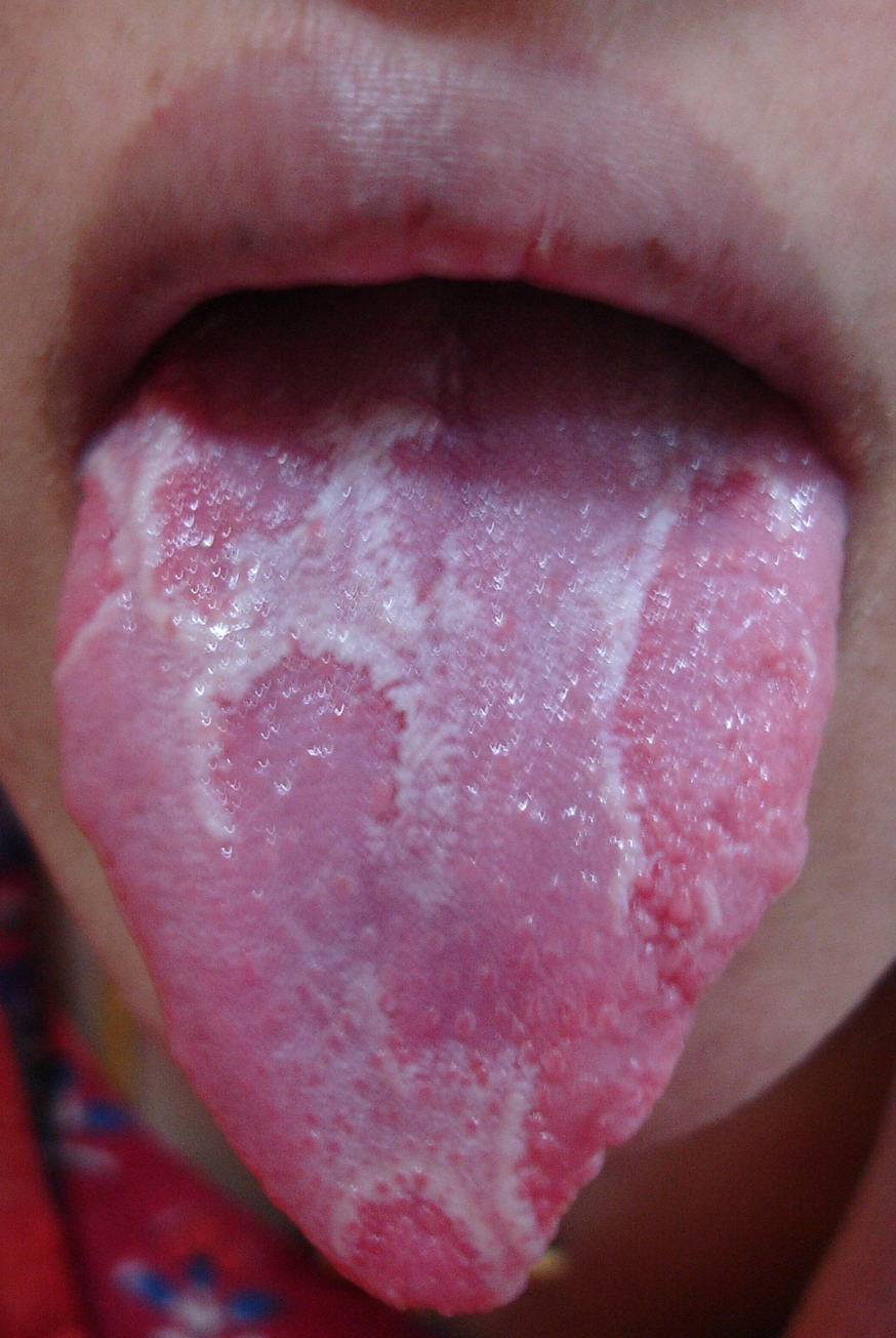 geographic tongue pic