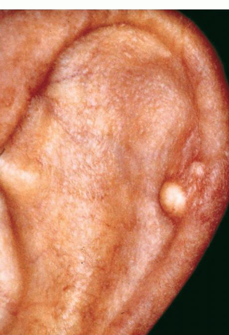 Gout in Adults: Condition, Treatments, and Pictures ...