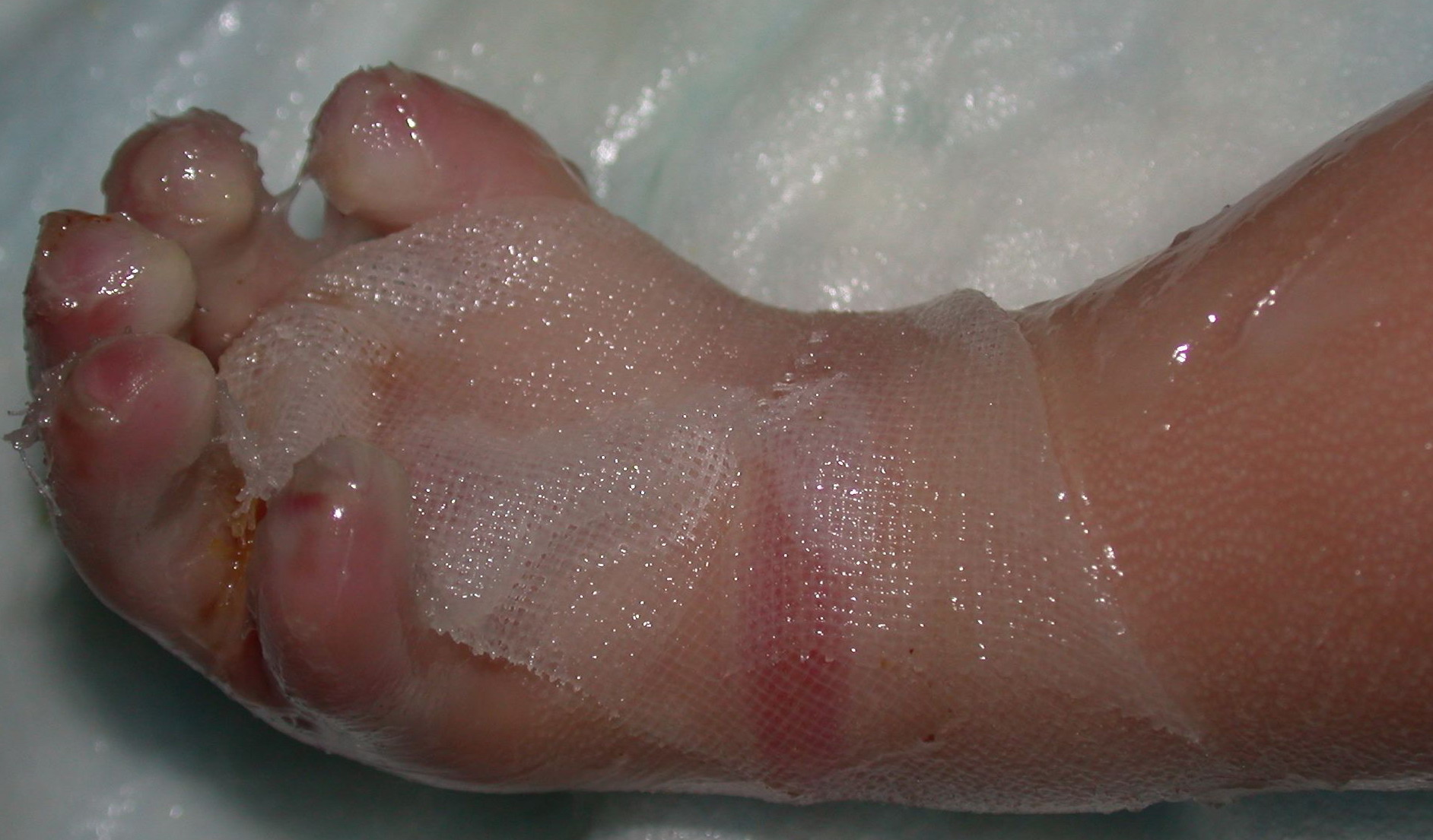 Ichthyosis Vulgaris: Causes, Symptoms, and Diagnosis