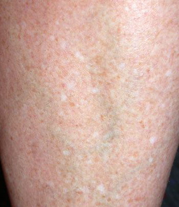 Dermnet: Dermatology Pictures - Skin Disease Pictures