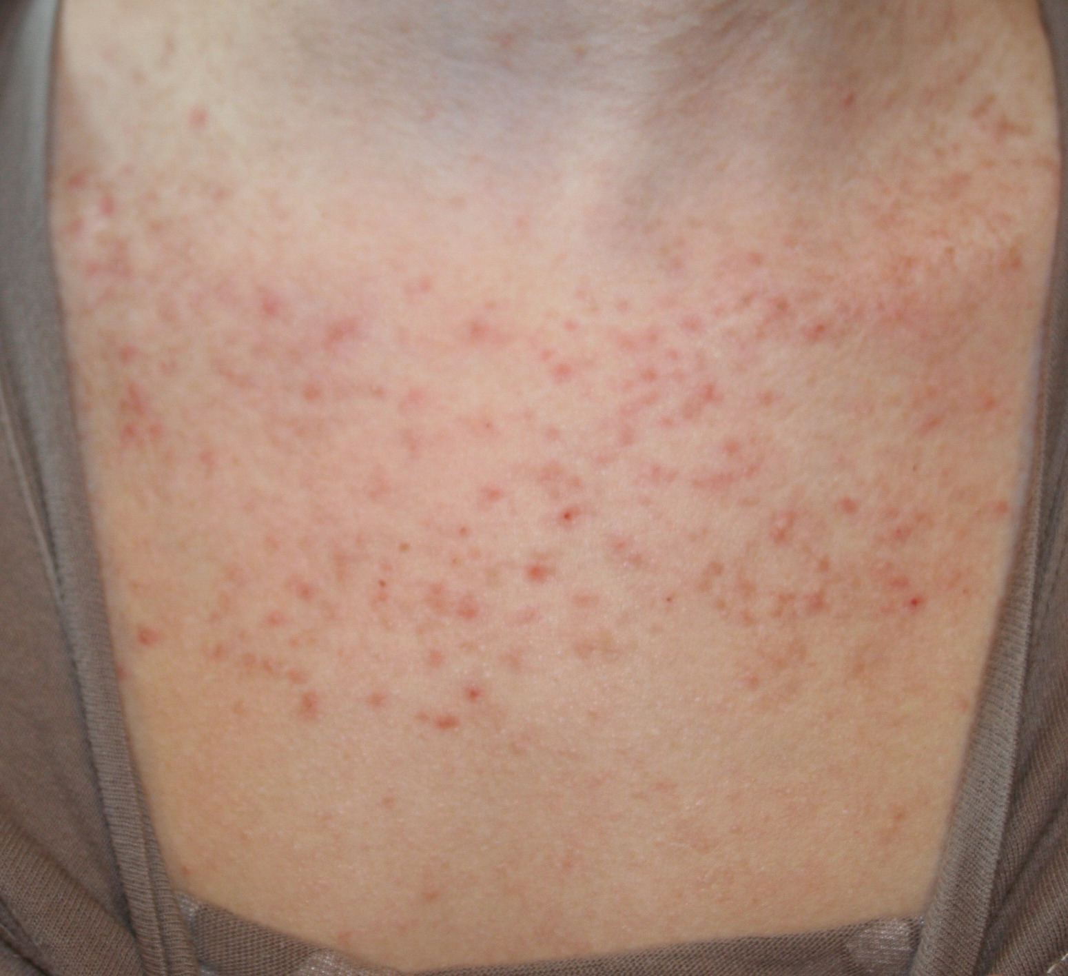 pictures of keratosis pilaris