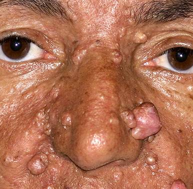 basal cell nevus syndrome