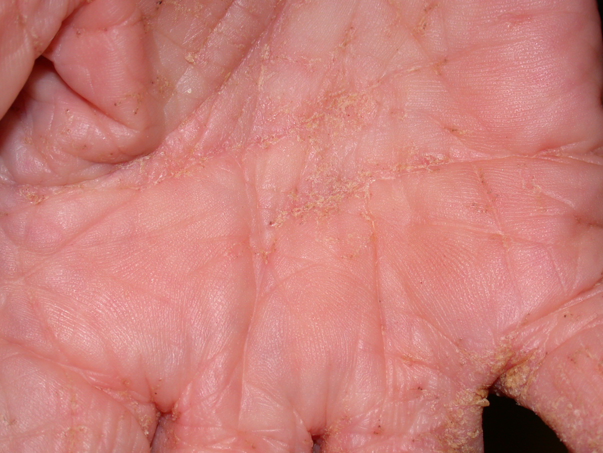 Norwegian Scabies - Risks, Symptoms and Leading Causes ...