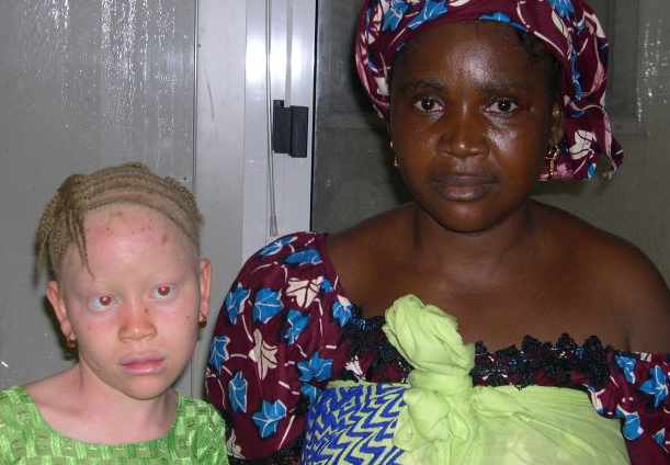 -year-old Albino people