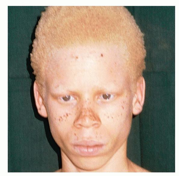 albinism pics