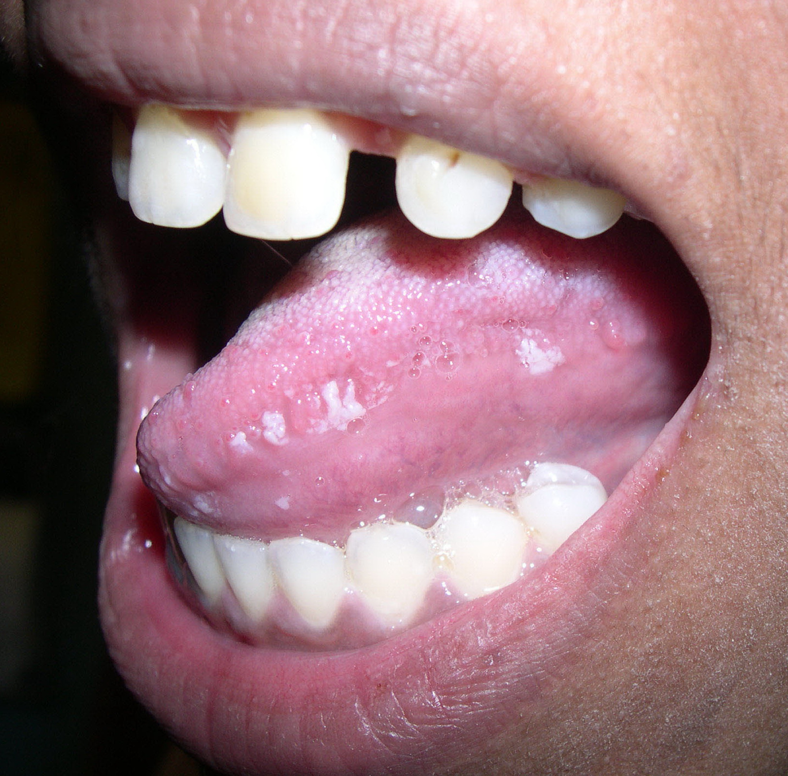 Leukoplakia - Mayo Clinic